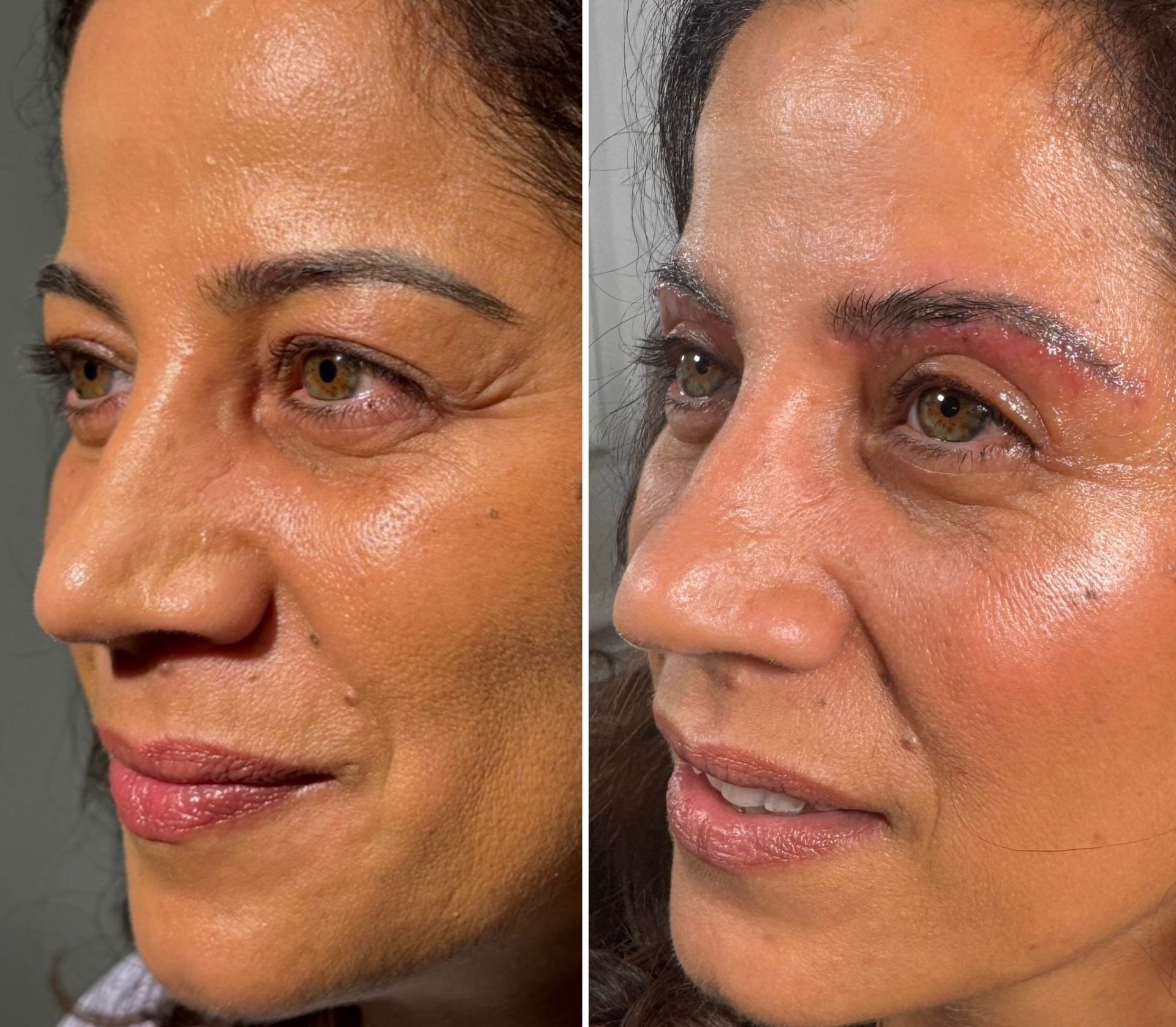 Korean Technique Upper Eye Lid Surgery London | Dr Deniz Kanliada