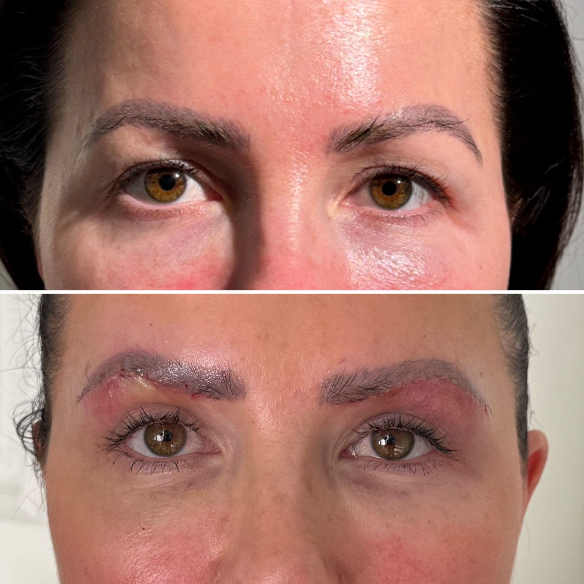 Korean Technique Upper Eye Lid Surgery London | Dr Deniz Kanliada