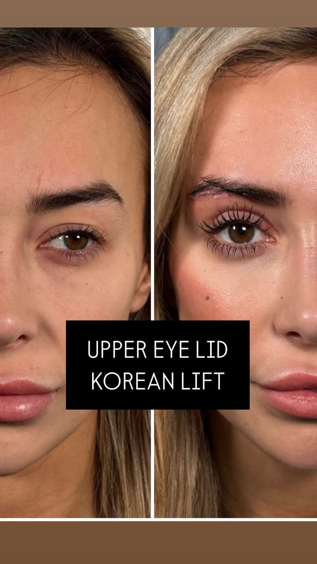 Korean Technique Upper Eye Lid Surgery London | Dr Deniz Kanliada