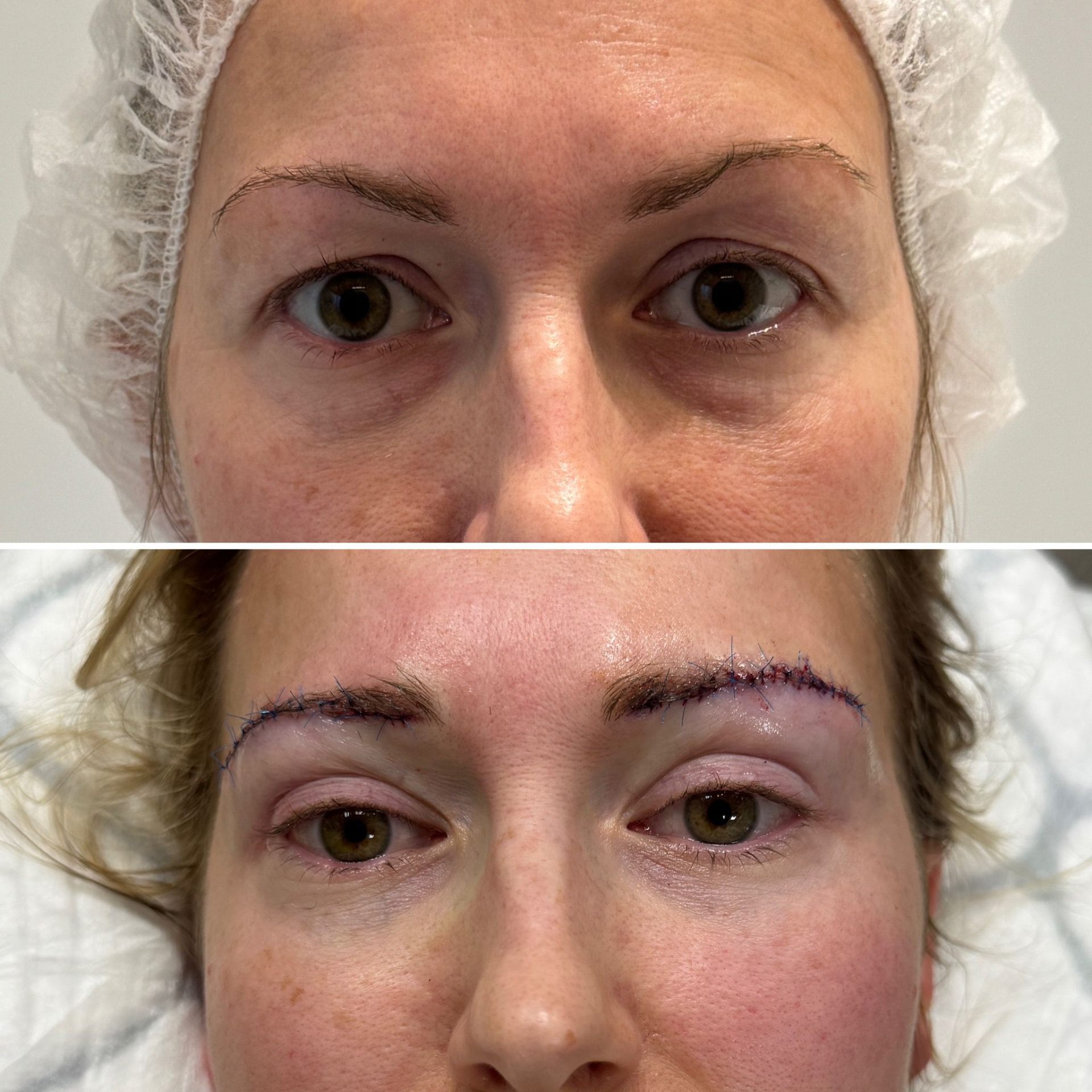 Korean Technique Upper Eye Lid Surgery London | Dr Deniz Kanliada