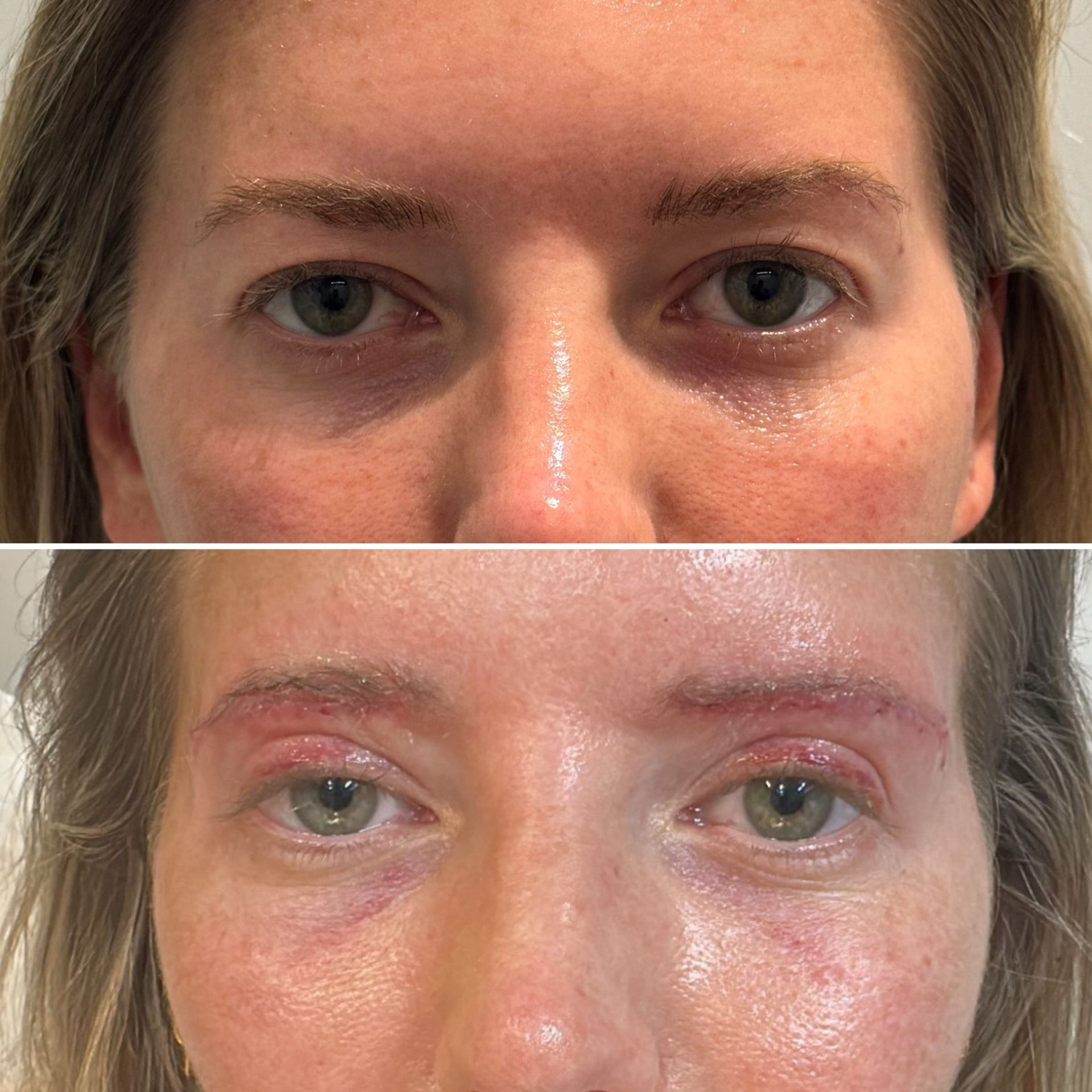 Korean Technique Upper Eye Lid Surgery London | Dr Deniz Kanliada