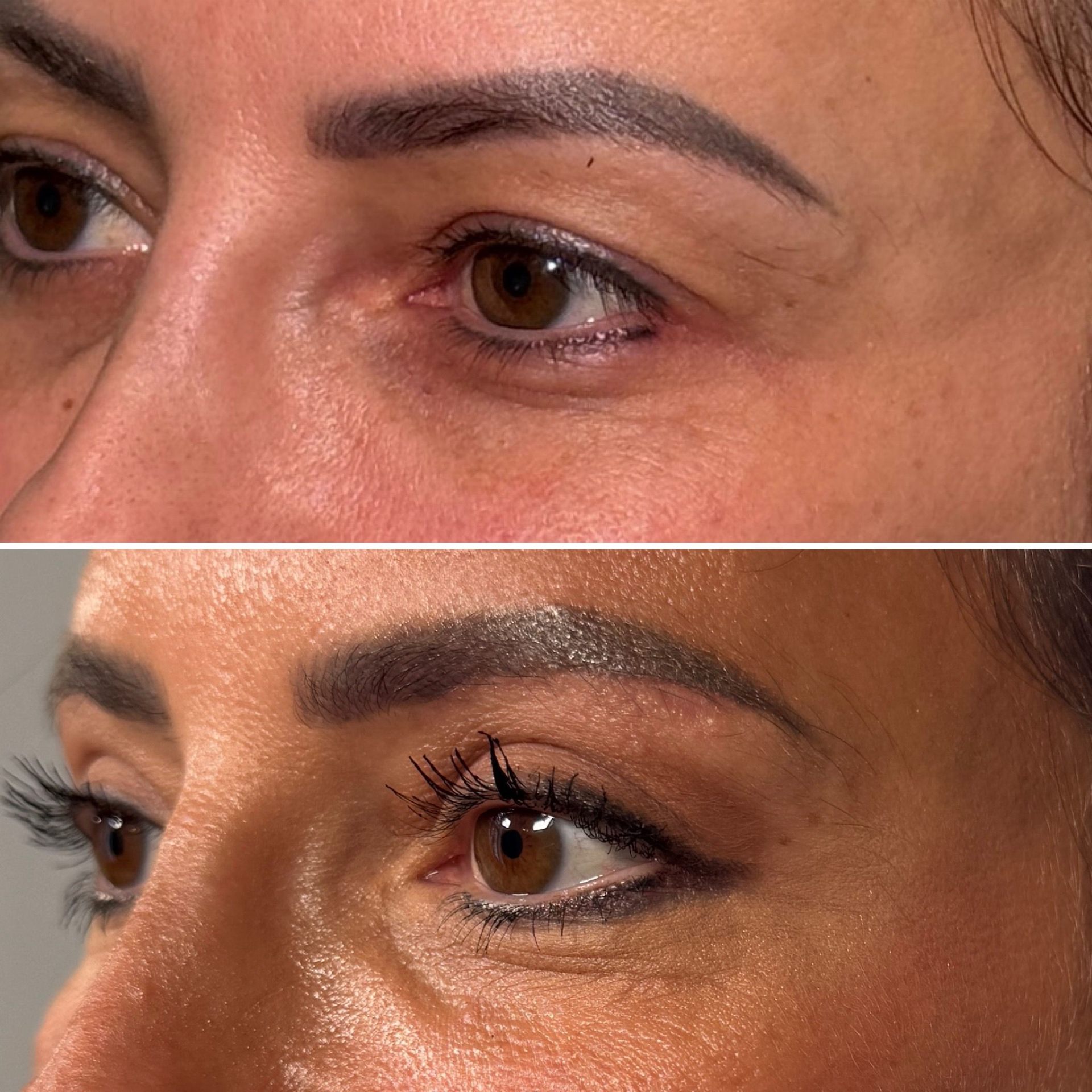 Korean Technique Upper Eye Lid Surgery London | Dr Deniz Kanliada