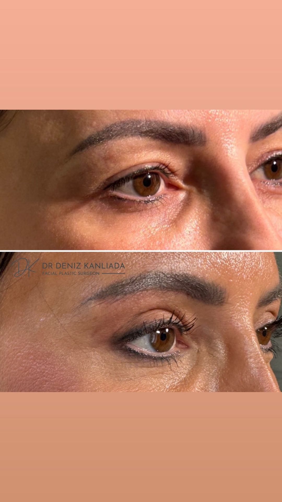 Korean Technique Upper Eye Lid Surgery London | Dr Deniz Kanliada