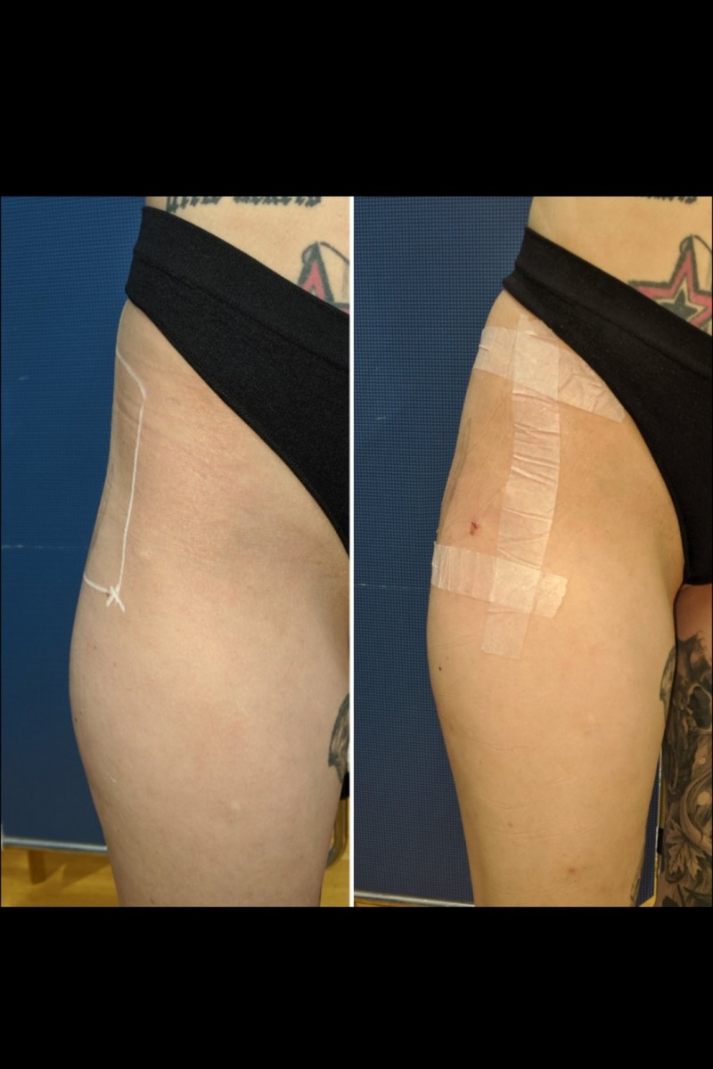 Non-Surgical Butt Lift, Body Contouring, Hip Dip Fillers