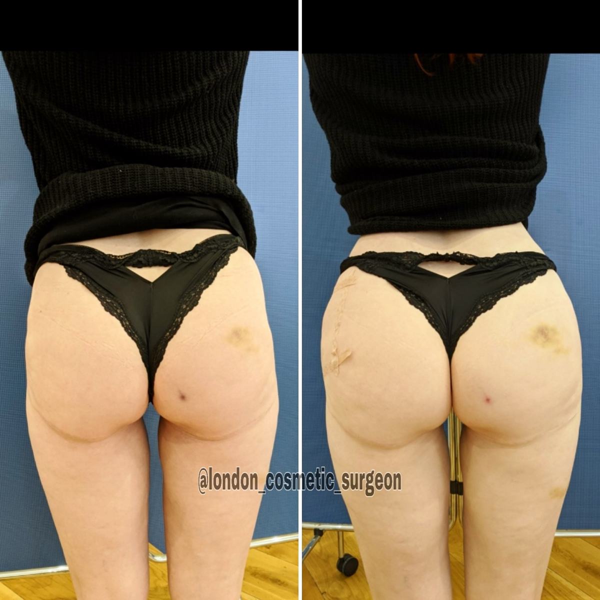 Non-Surgical Butt Lift, Body Contouring, Hip Dip Fillers