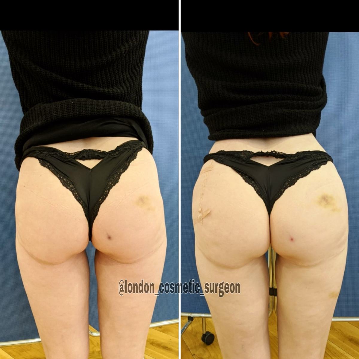 https://www.drdenizkanliada.com/wp-content/gallery/butt-lift-nonsurgical/IMG_20200301_110353_427.jpg