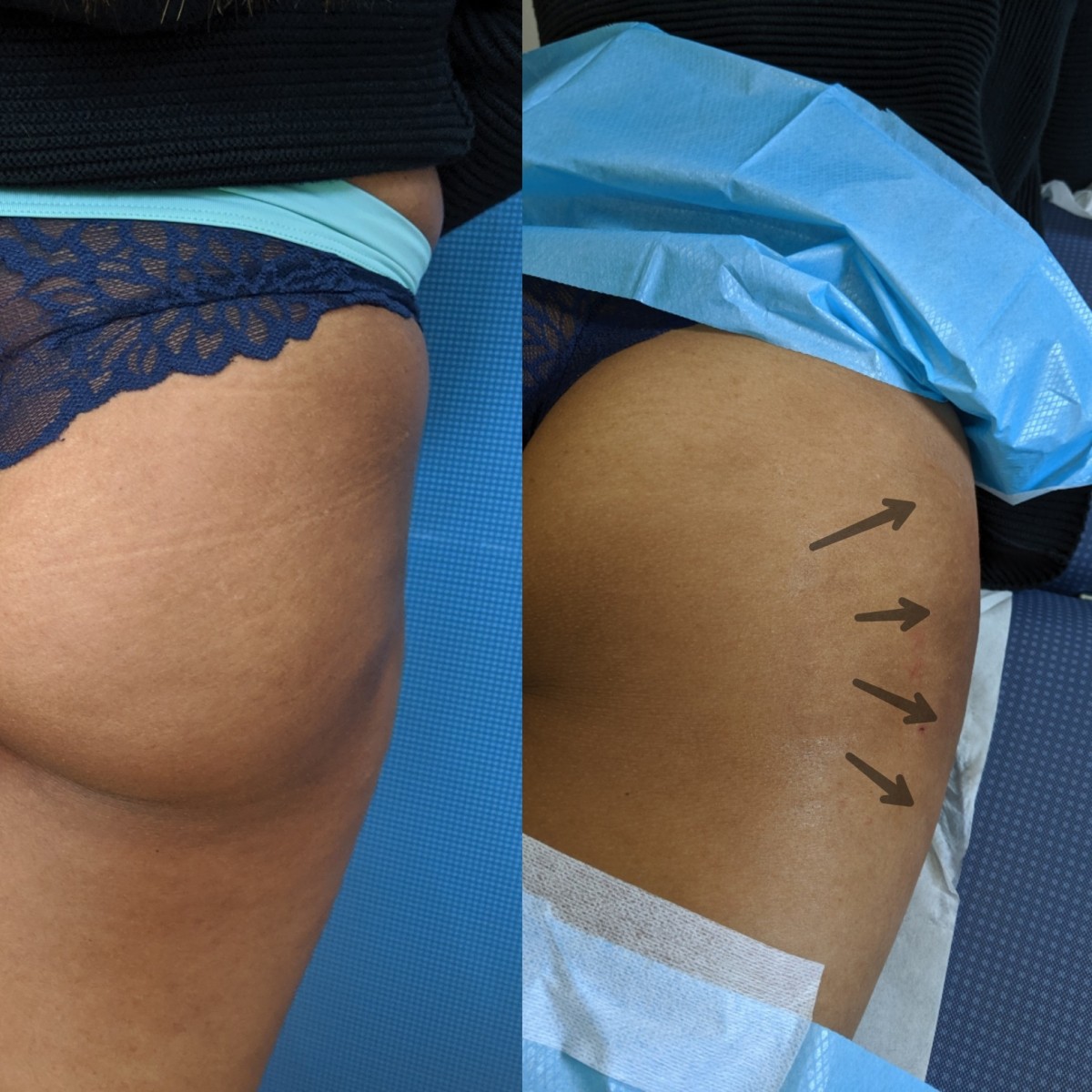 Best Doctor for Thigh Fat Removal - Surgical and Non-Surgical Treatment