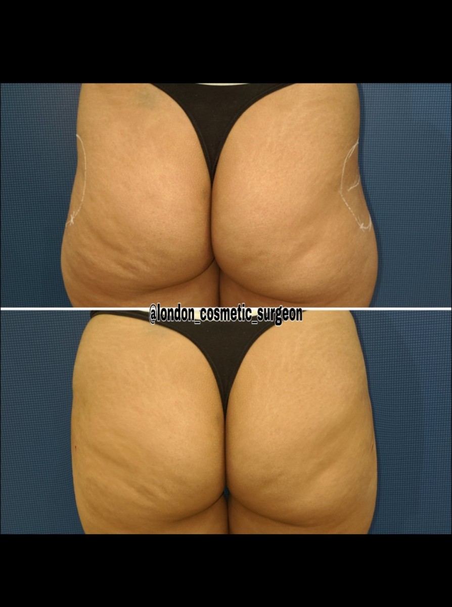 Non-Surgical Butt Lift, Body Contouring, Hip Dip Fillers