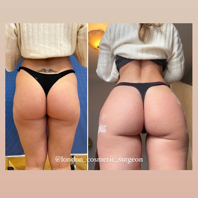Non Surgical Butt Lift Body Contouring Hip Dip Fillers Dr