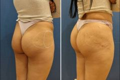 Enhance Me - Permanent Cosmetics & Aesthetics - Hip Dip Filler🍑 A  specialist Dermal Filler is inserted via a cannula into the buttock towards  to hip area to reduce hip dips by